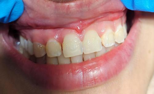 1 - Przed Bondingiem