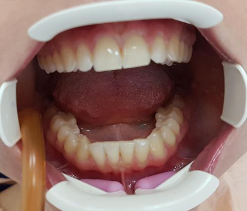 2 - Przed Wybielaniem