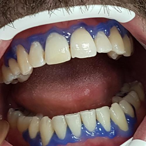 1 - Przed Wybielaniem